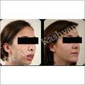 Manufacturers Exporters and Wholesale Suppliers of Chin Augmentation Treatments New Delhi Delhi